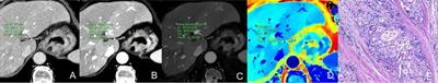 Dual-layer dual-energy CT for improving differential diagnosis of squamous cell carcinoma from adenocarcinoma at gastroesophageal junction